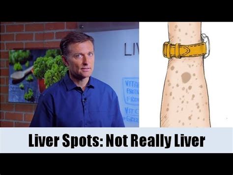 What Causes Liver Spots Aging Spots Hintits Not The Liver
