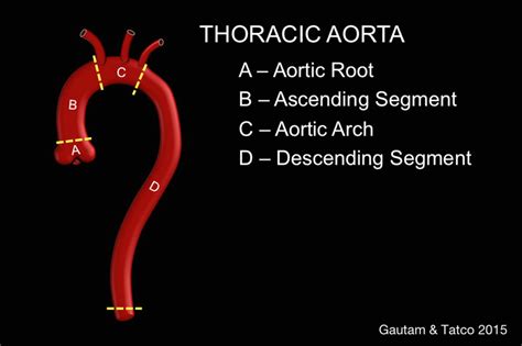 Segments Of The Thoracic Aorta Download Scientific Diagram