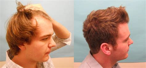 Video Approach For Young Men Experiencing Hair Loss Hair Transplant