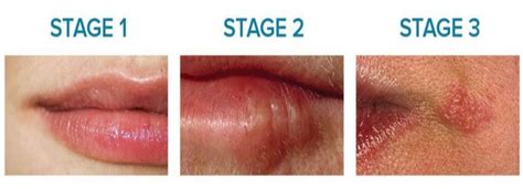 Early Stage Of Herpes On Lip