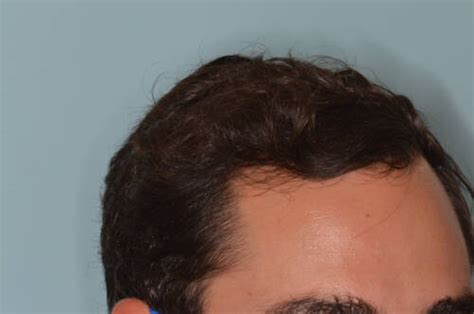 Hair Restoration For Men Anthony Bared M D F A C S