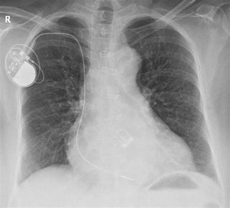 Single Chamber Pacemaker And Aortic Prosthetic Valve All About