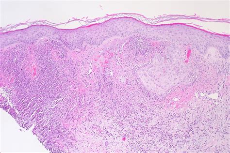 When Sweet Turns Sour An Unusual Case Of Acute Febrile Neutrophilic