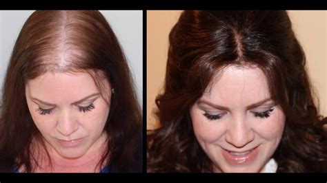 Many new moms see noticeable hair loss a few months after having a baby. Human Hair topper before and after pictures | Women ...