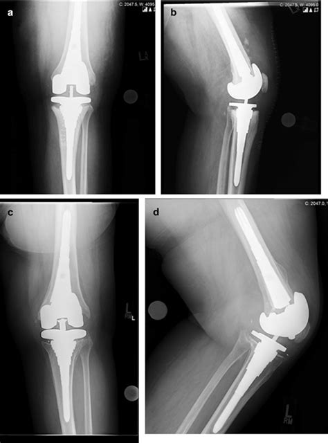 Anteroposterior Ap A And Lateral B Radiographs Obtained At