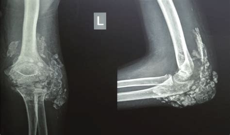 Preoperative Radiograph Of Left Elbow Showing Calcified Mass Over