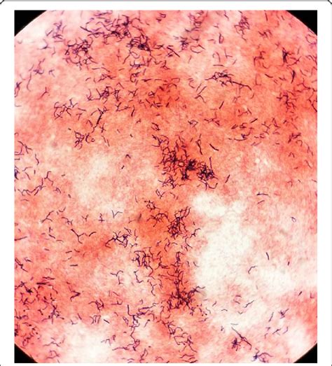 Gram Stain Of The Isolates Grown In Culture Showing Grampositive