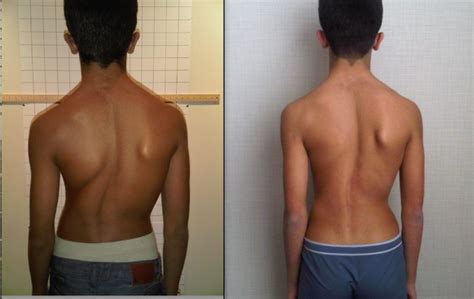 What Are The Early Signs Of Scoliosis Premierechiro