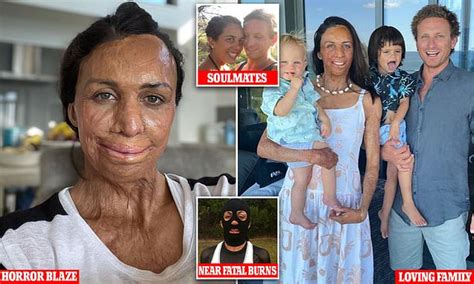 Turia Pitt Opens Up About Life Changing Fire That Saw Almost Burnt Her Alive Years On Daily