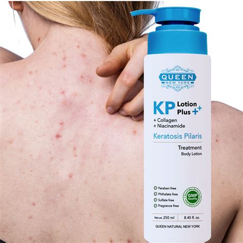Buy Queen Kp Plus Keratosis Pilaris Exfoliating Body Lotioncollagen