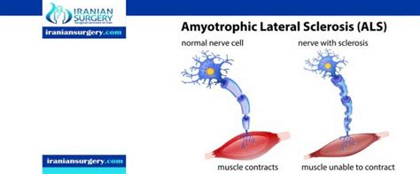 Amyotrophic Lateral Sclerosis Radiology Iranian Surgery