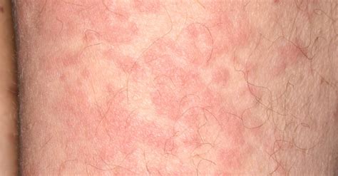 Spotting The Signs Of Covid 19 Related Skin Conditions Nursing In