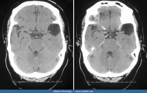 Arachnoid Cyst Medlink Neurology