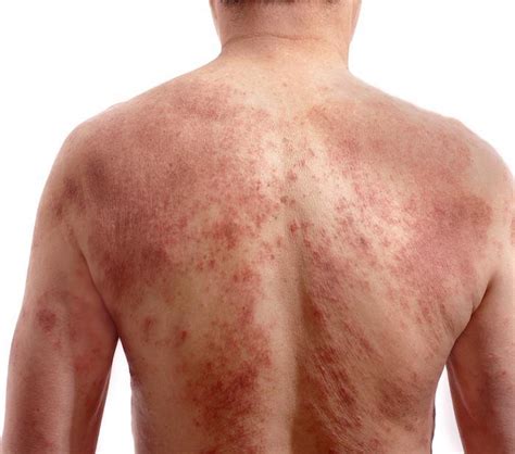 Common Eczema Triggers Advanced Allergy And Asthma Allergists