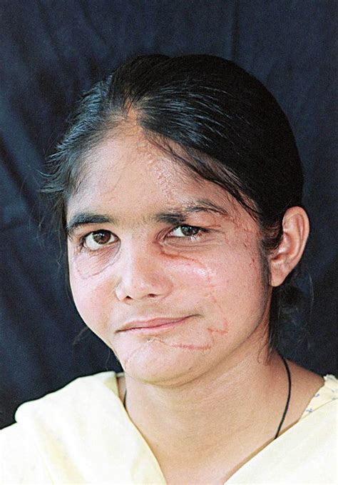 World S Most Amazing Miracle Face Transplants After Horrific Life