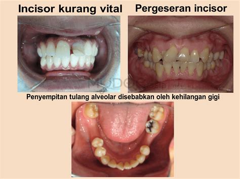 Jahe yang dikenal sebagai obat tanaman keluarga ini ternyata juga efektif untuk menghentikan nyeri saat sakit gigi menyerang. Harga Pasang Braces Di Klinik Kerajaan 2020
