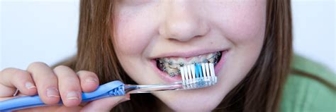 Caring For Your Braces Important Tips Ridentes Dental Kidlington