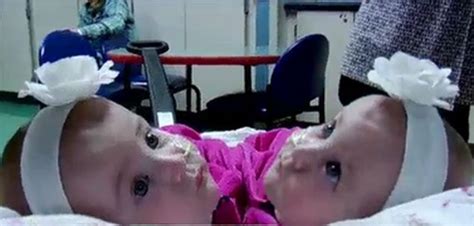 Surgeons Separate Conjoined Ny Twins Ny Daily News