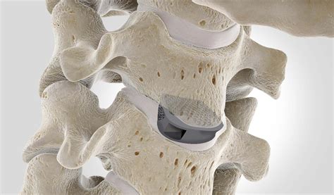 Anterior Cervical Discectomy Fusion Acdf Depuy Synthes Jandj