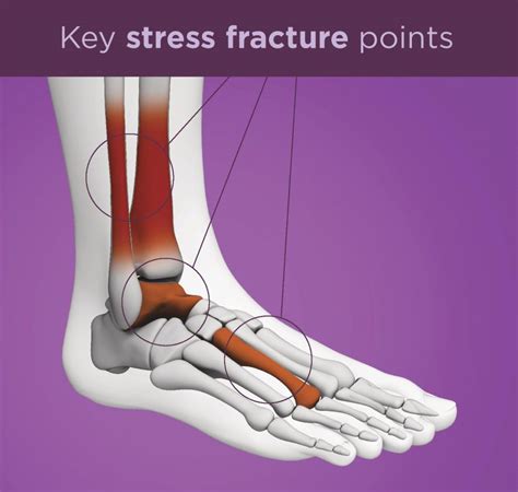 Stress Fractures Causes Treatment And Prevention Upmc Healthbeat