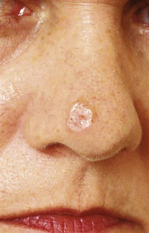 Melanoma Nose