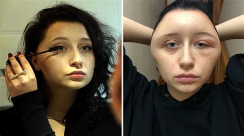 Womans Allergic Reaction To Hair Dye A French Woman Identified Only
