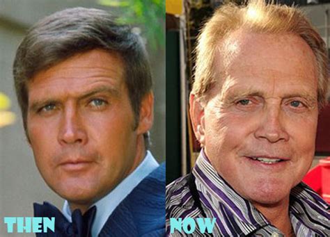 Lee Majors Plastic Surgery Before After Pictures Lovely