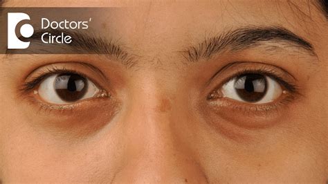 Normal fat that helps support the eyes can then move into the lower eyelids, causing the lids to appear puffy. What Causes White Bags Under My Eyes