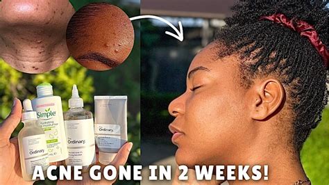 Visibly Clearer Skin In 2 Weeks Easy 4 Step Skincare Routine Youtube