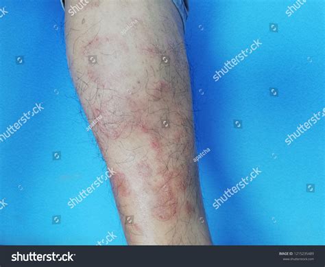 Eczema Rash Skin Leg Stock Photo 1215235489 Shutterstock