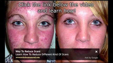 How To Cure Blotchy Skin Skin Care Tips Blotchy Skin On Face Youtube