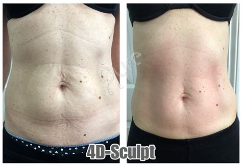 Amazing Skin Tightening Results With 4d Sculpt Puregenex Inch Loss