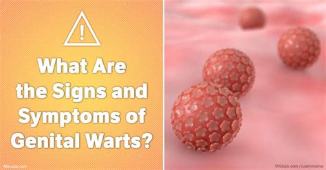 genital warts guide causes symptoms and treatment options images