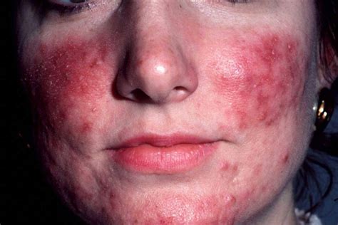 I have only had rosacea for a few years, came on a little while after i had a baby. Ivermectine crème tegen rosacea maakt indruk - Huidarts.com