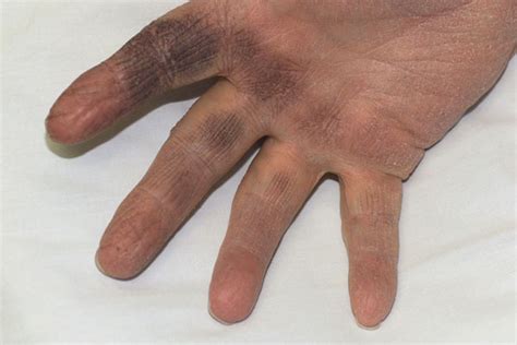 Derm Dx Black Discoloration Of The Hands Clinical Advisor