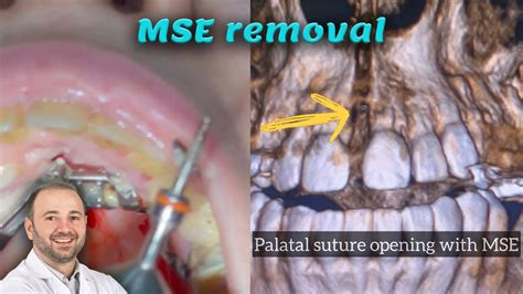 Mse Before And Aftermaxilla Skeletal Expansionmse Removal After