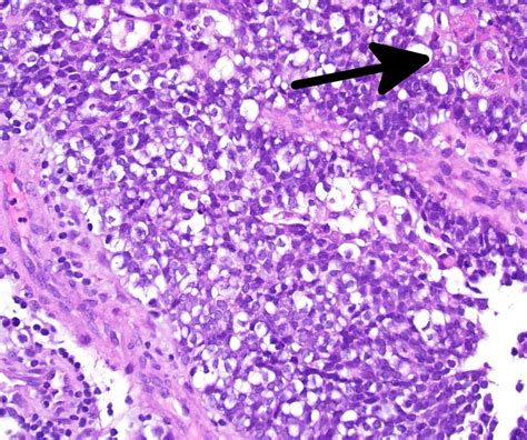 Cureus Leptomeningeal Carcinomatosis From Squamous Cell Carcinoma Of