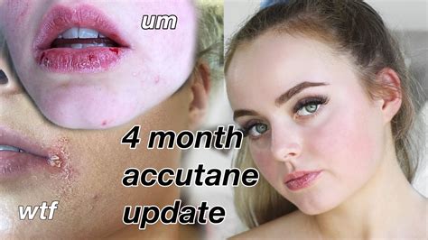 MONTH ACCUTANE UPDATE HORRIBLE SIDE EFFECTS Conagh Kathleen YouTube