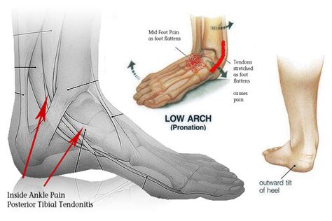 Ankle Pain Causes Symptoms Treatment Ankle Pain