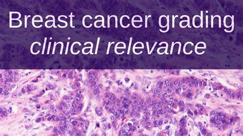 How To Grade Breast Cancer Clinical Relevance Youtube