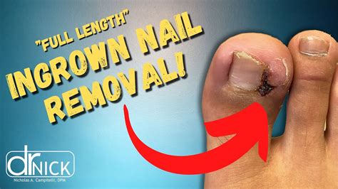 Ingrown Toenail Surgery Narrated By Dr Nick Youtube