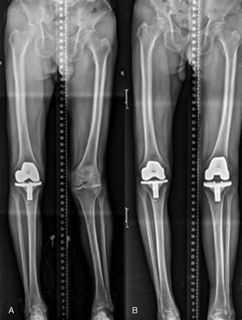 Scanogram Revealed Valgus Osteoarthritis On His Left Knee Preoperative Download Scientific