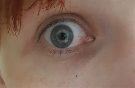 Skin Concerns Redness And Lines Under My Eyes What Are My Options To