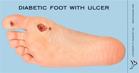 Causes And Symptoms Of Diabetic Foot Mass4d® Insoles Mass4d® Foot