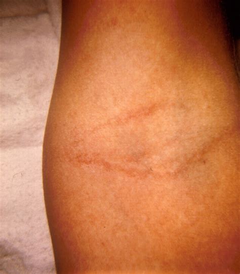 Briefs Fever And Rash Whats The Diagnosis Healthynewsusa Keeping