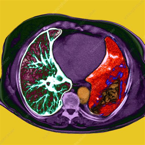 Lung Cancer Ct Scan Stock Image M1340563 Science Photo Library