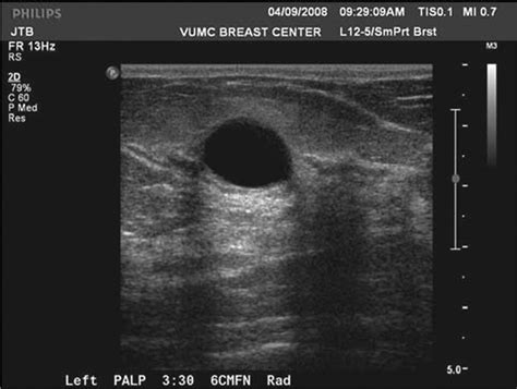 Breast Cyst Ultrasound