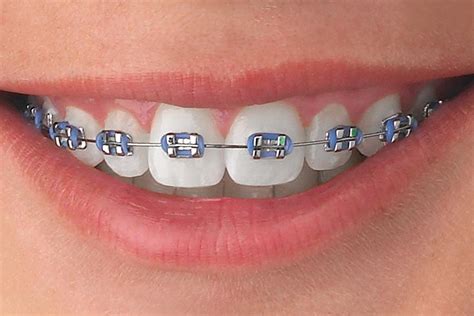 Fixed Dental Braces Wirral Lakeside Orthodontics