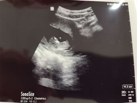 11 Week Ultrasound Any Guesses On Gender Babycenter