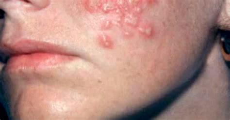 Herpes Rash On Face Treatment Herpes Zoster Shingles Affecting